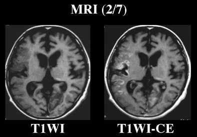 NMC Diagnosis