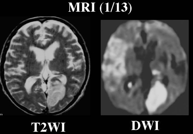 NMC Diagnosis