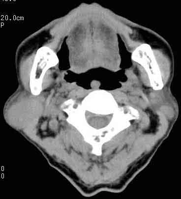 NMC Diagnosis